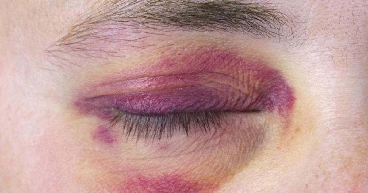 black eye