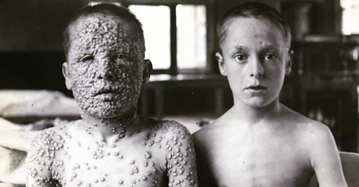 HIstorical photograph of two boys exposed to smallpox, one who had been vaccinated and one who had not.