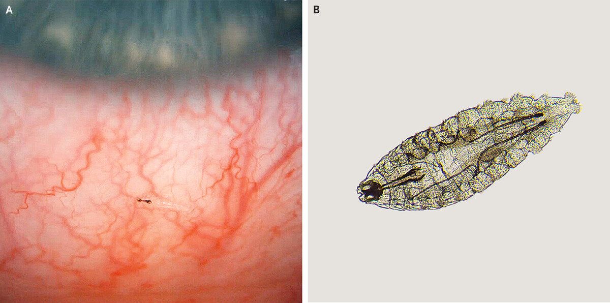 eyeball maggots, sheep botfly larvae