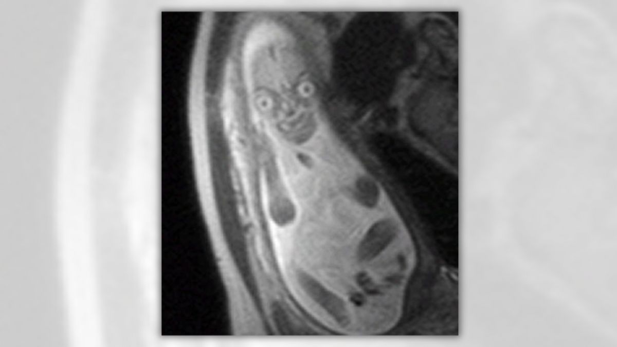 An X-ray shows what looks like a bowling pin with an evil face appearing on it.