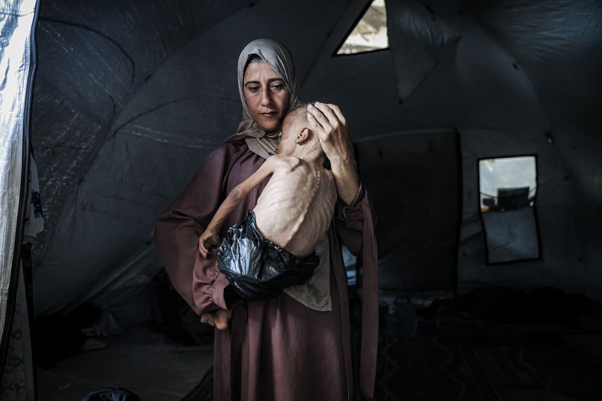 A severely malnourished child showing signs of starvation being held by a woman looking into the camera. 