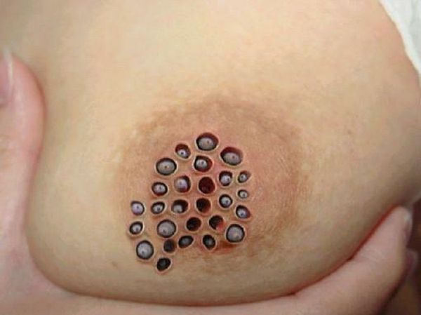south american larvae breast rash