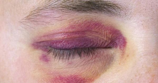 black eye