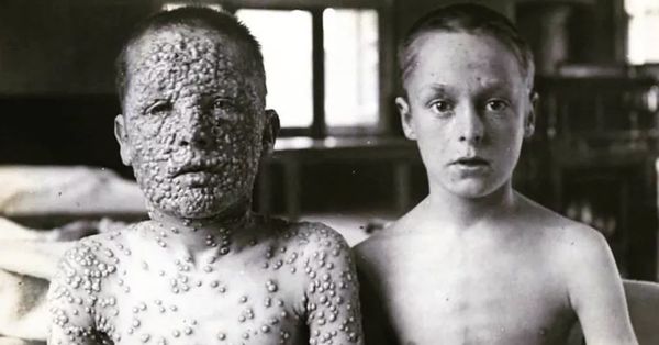 HIstorical photograph of two boys exposed to smallpox, one who had been vaccinated and one who had not.