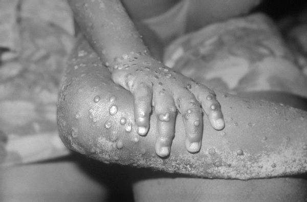 Can Monkeypox Be Considered an STD?