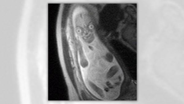 An X-ray shows what looks like a bowling pin with an evil face appearing on it.