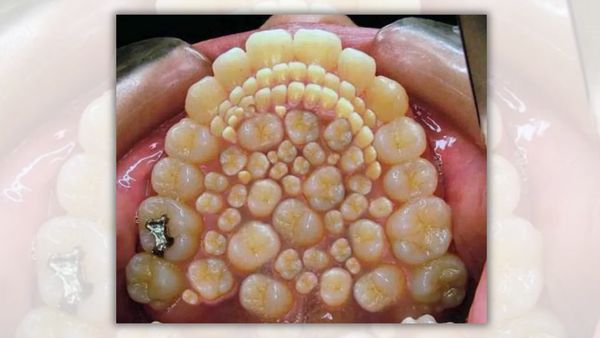 A group of teeth are shown. They are all slightly yellow.